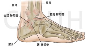 腳踝扭傷的治療與保健