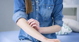 異位性皮膚炎預防與保健