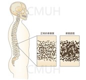 骨虛損(骨質疏鬆症)的預防保健