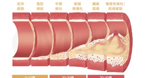 冠狀動脈粥樣硬化