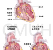 陣發性心室上心搏過速