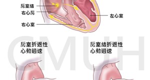 陣發性心室上心搏過速