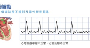 心房顫動