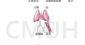 深層靜脈栓塞