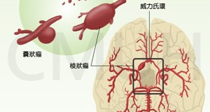 蜘蛛膜下腔出血