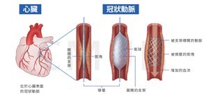 冠狀動脈氣球擴張與支架置放術