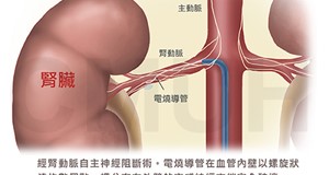 經腎動脈自主神經阻斷術治療頑固型高血壓