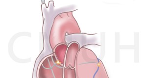 雙心室再同步心律調節器