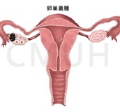 卵巢囊腫