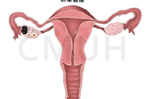 卵巢囊腫