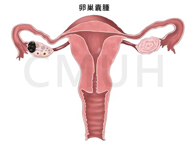 卵巢囊腫