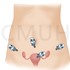 腹腔鏡全子宮切除手術