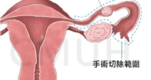 腹腔鏡子宮外孕手術
