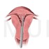 經子宮頸子宮内視鏡子宮中隔切除手術
