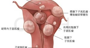 子宮肌瘤