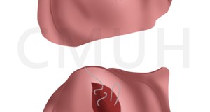 腹腔鏡子宮肌瘤切除手術