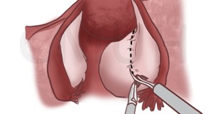 腹腔鏡卵巢(囊腫)／輸卵管切除手術