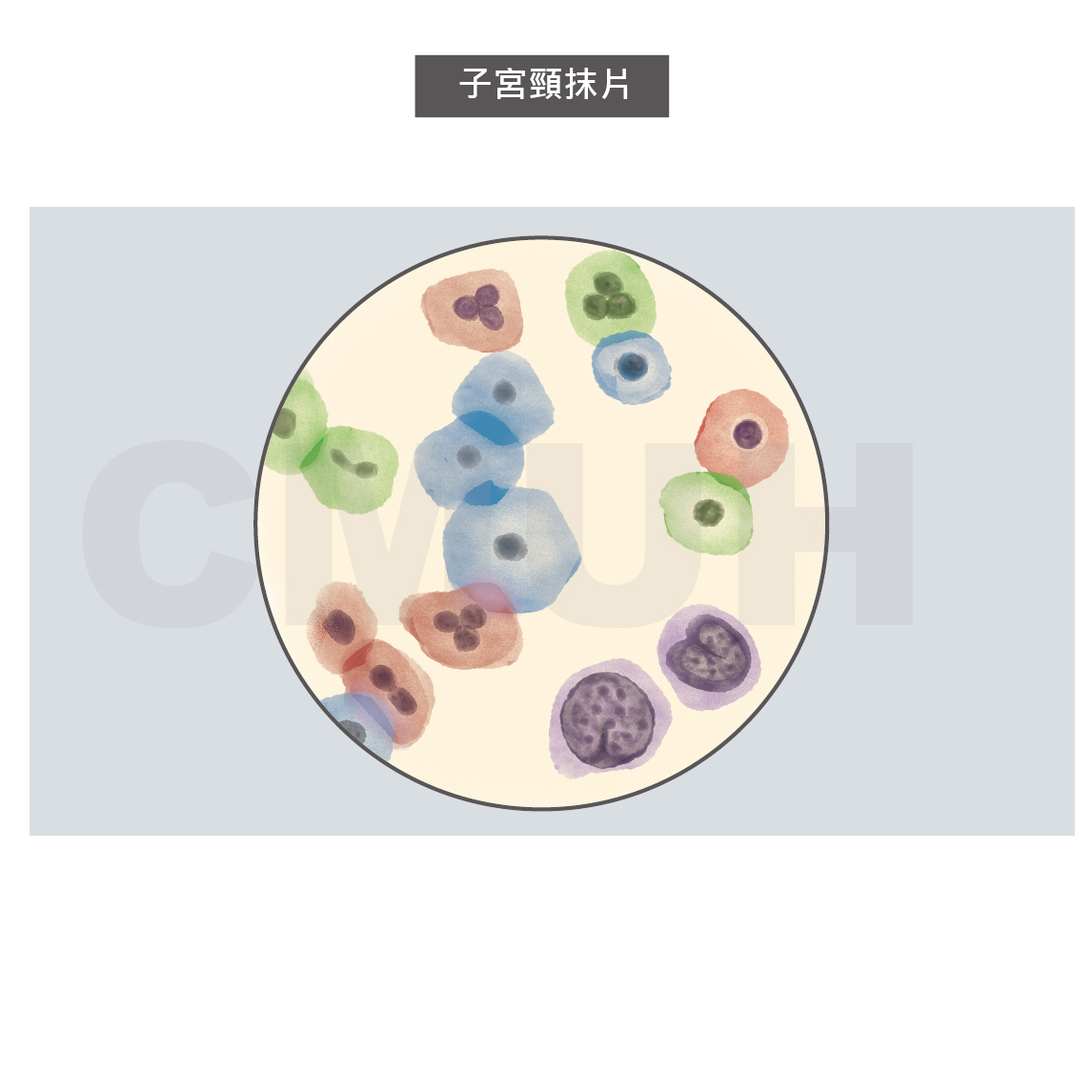 子宮頸細胞化生不良與上皮內腫瘤