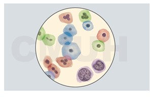 子宮頸細胞化生不良與上皮內腫瘤