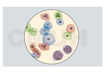 子宮頸細胞化生不良與上皮內腫瘤