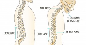 僵直性脊椎炎的治療和保健