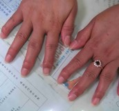 防治退化性關節炎要趁早