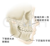正顎手術