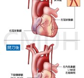 冠狀動脈繞道手術
