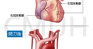 冠狀動脈繞道手術