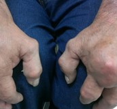 高尿酸血症會增加心血管疾病死亡風險 