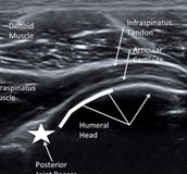 超音波導引疼痛微創治療分享
