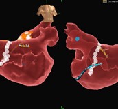 心臟電氣生理學檢查及電氣燒灼手術