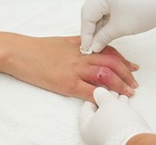 增生性疤痕與蟹足腫