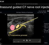 頸椎神經根注射