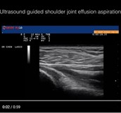 肩關節積水抽吸