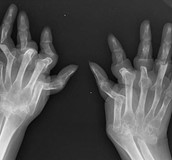 類風濕性關節炎之達標治療