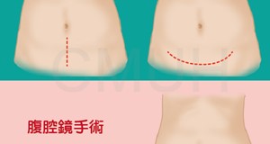 單孔腹腔鏡手術