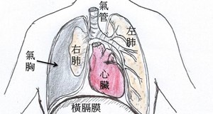 青少年突然胸痛要小心!