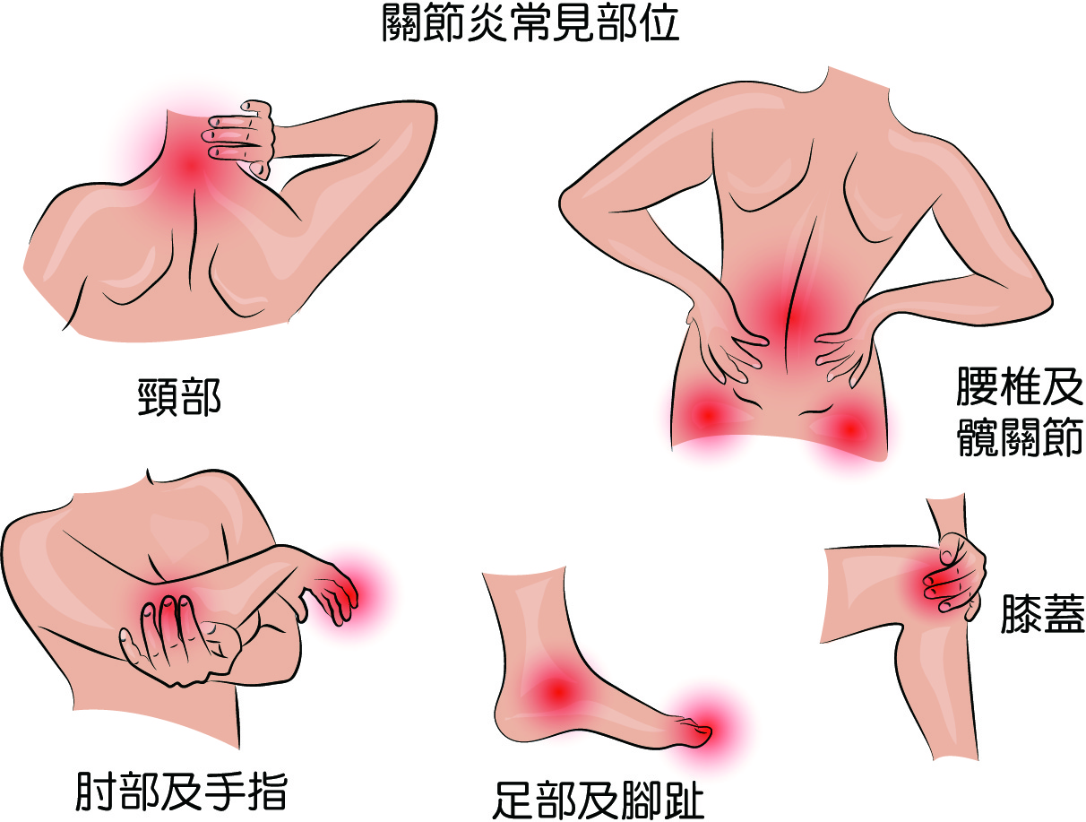 關節炎的圖片搜尋結果