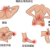自體脂肪幹細胞搶救退化性關節炎
