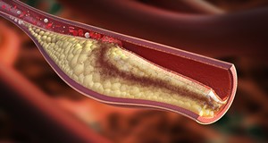 護腦顧命救神經急性腦血管梗塞治療新趨勢