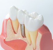 植牙的協同治療及美學考量