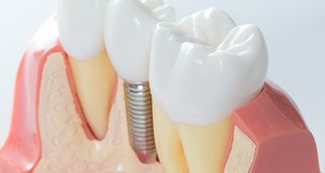 牙科植體術後衛教說明