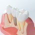 牙科植體術後衛教說明