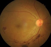 視網膜病變分類