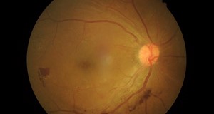 視網膜病變分類