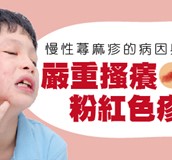 慢性蕁麻疹患者看過來！