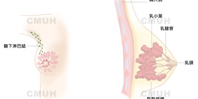 乳癌