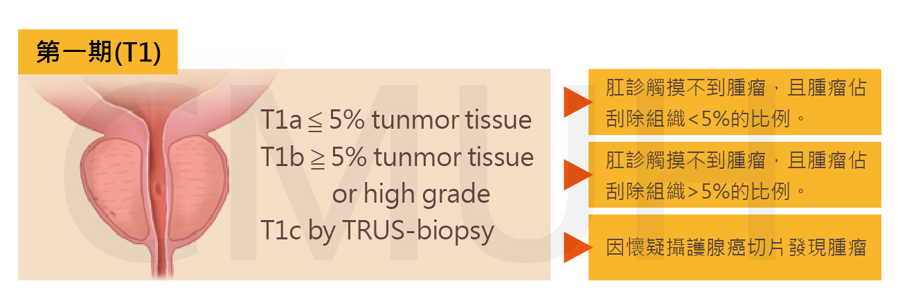 攝護腺癌於治療前之評估
