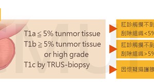 攝護腺癌於治療前之評估